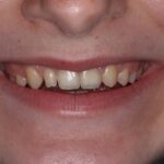 Composite resin restoration in dentistry | PPT