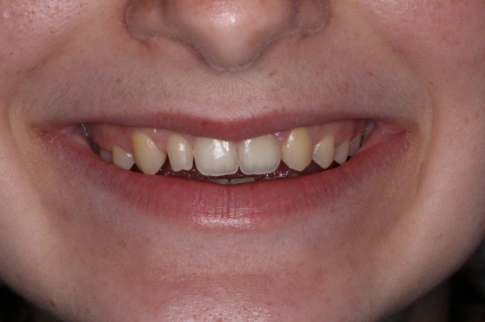 Composite resin restoration in dentistry | PPT